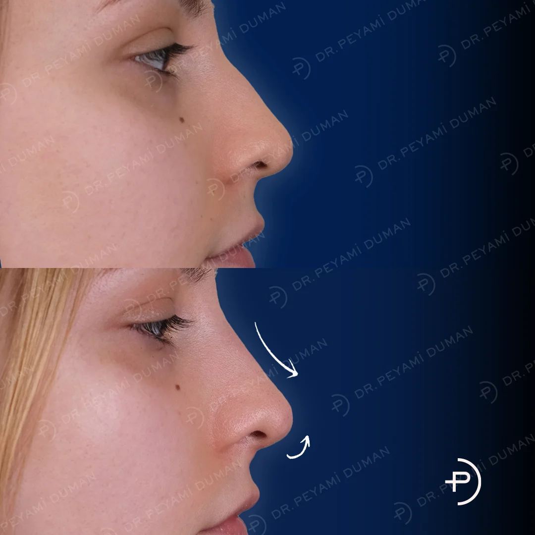 burun-estetigi-4
