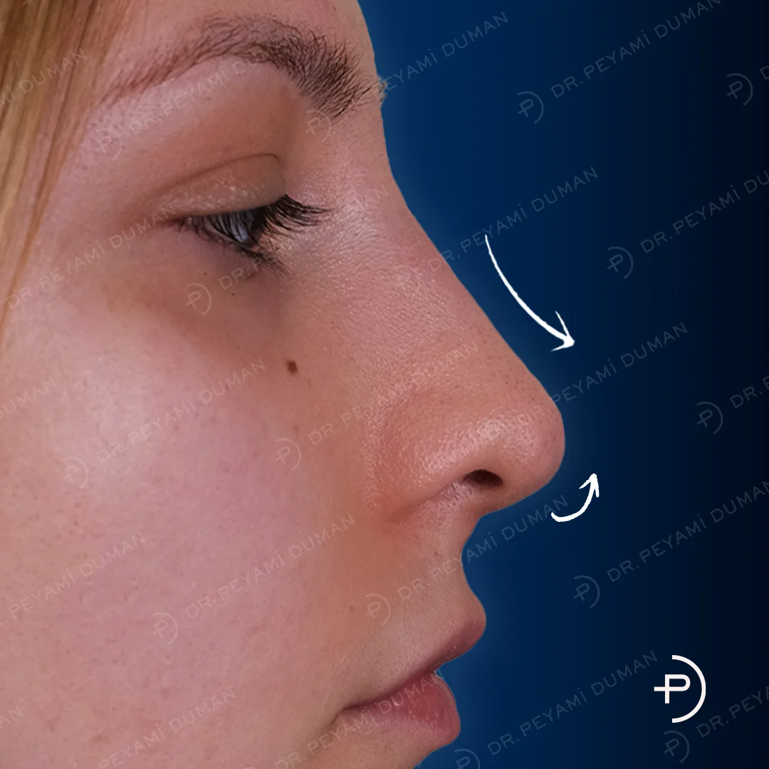 burun-estetigi-5