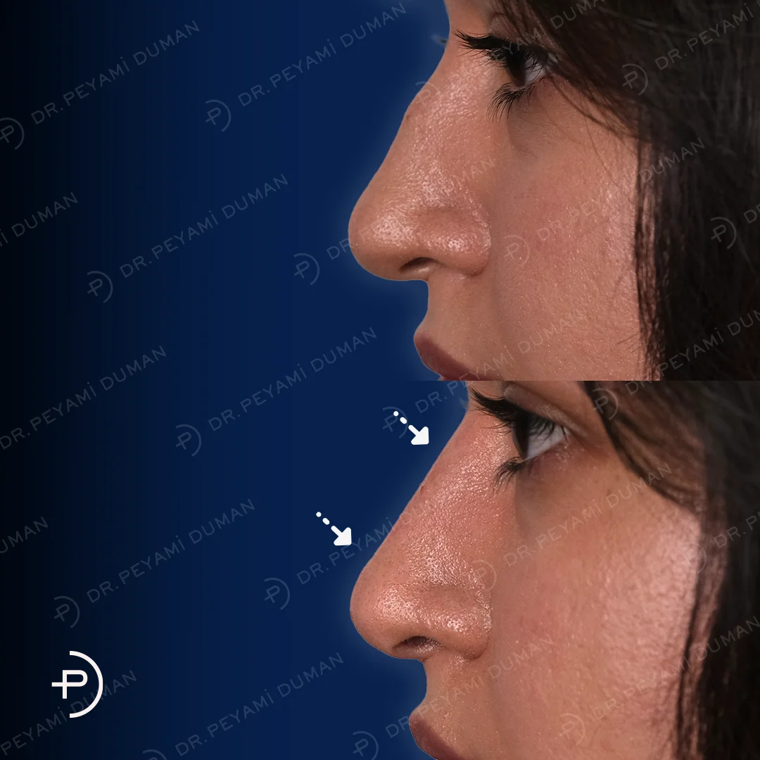 burun-estetigi-8