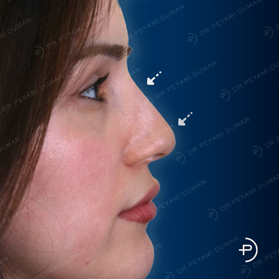 pd-burun-estetigi-2