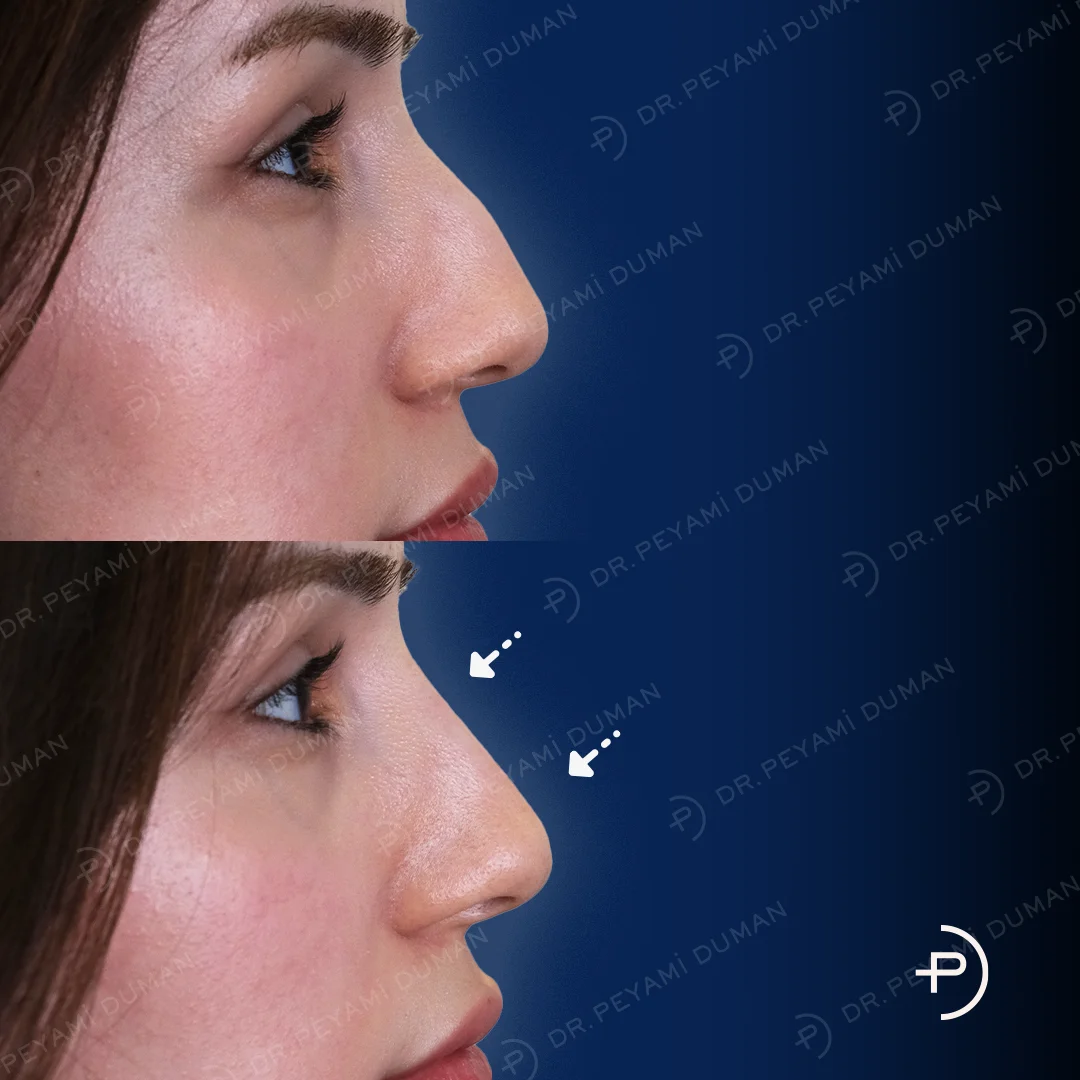pd-burun-estetigi-3