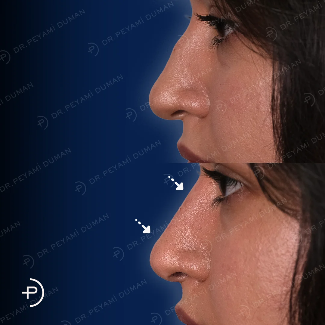 pd-burun-estetigi-7