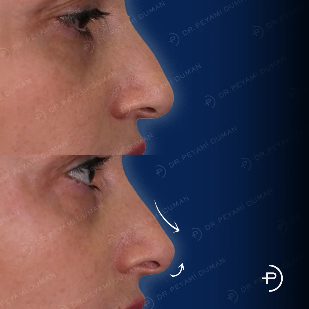 pd-burun-estetigi-9