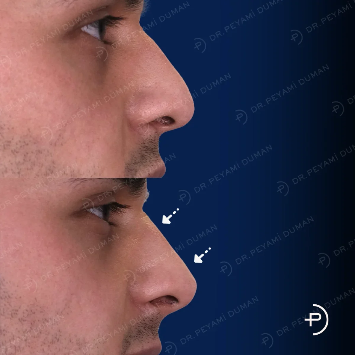 burun-estetigi-3