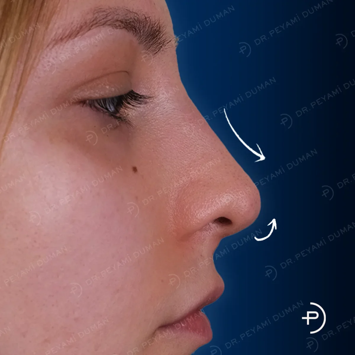 burun-estetigi-5