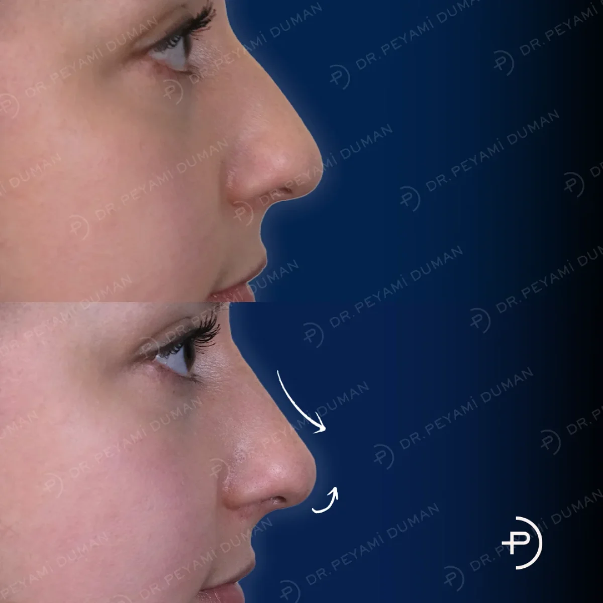 burun-estetigi-6