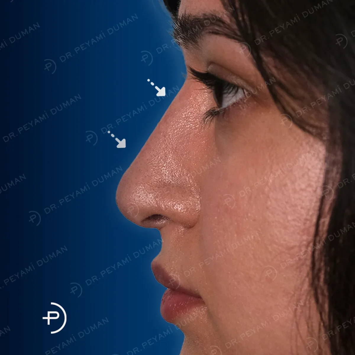 burun-estetigi-7
